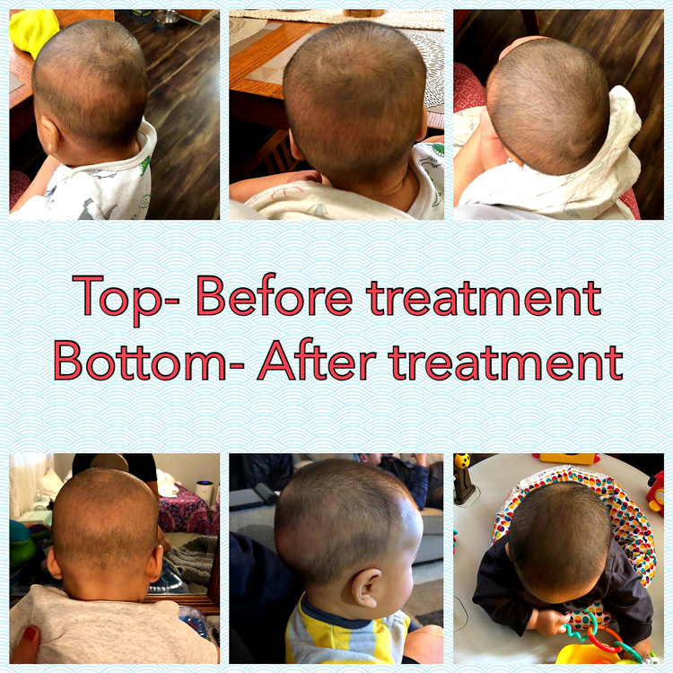 Chiropractic-Care-for-Torticollis-in-Simi-Valley-CA Chiropractic Care for Torticollis in Simi Valley CA